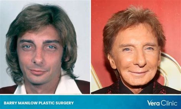 Barry Manilow Plastic Surgery, Has Barry Manilow Had Cosmetic Surgery? ·